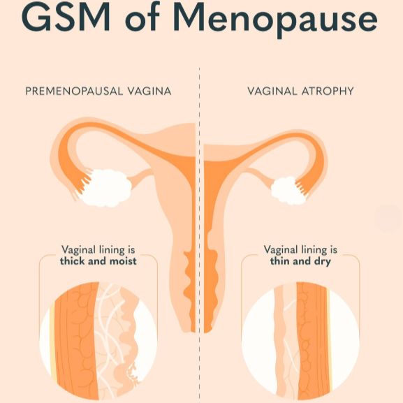 Understanding Genitourinary Syndrome of Menopause (GSM)